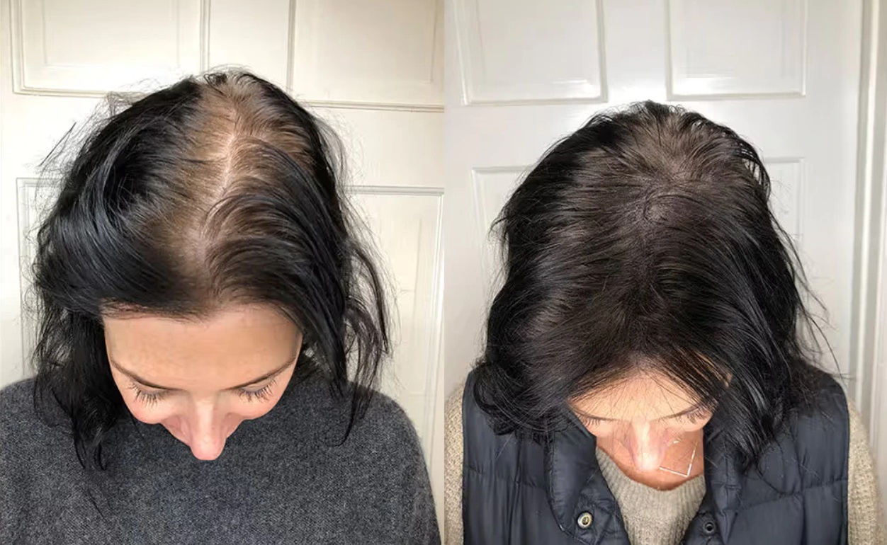 Woman before and after SMP for thinning hair