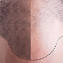 Scalp Micropigmentation (SMP): Everything You Need To Know