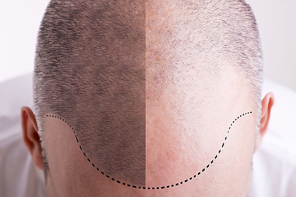 Scalp Micropigmentation