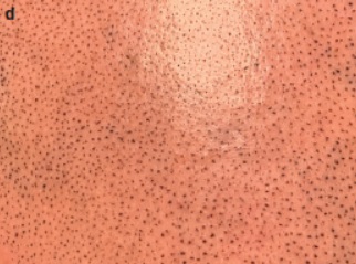 scalp micropigmentation dots up close