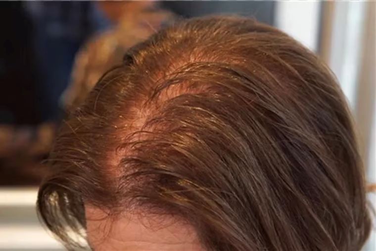 diffuse thinning around the parting due to female pattern baldness