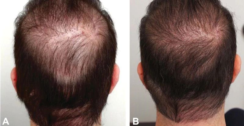 Beard hair used to perform crown hair transplant