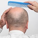 Where Does The Hair Come From For Hair Transplants?