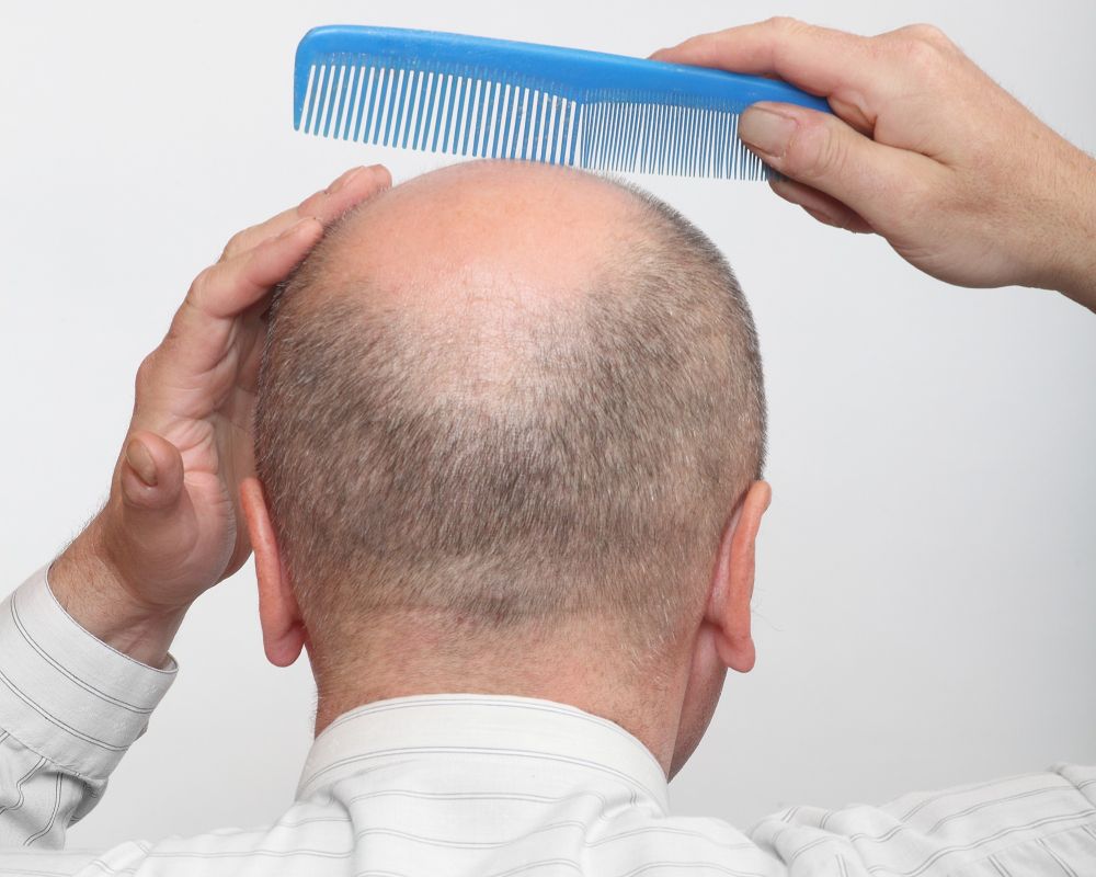 Where Does The Hair Come From For Hair Transplants?