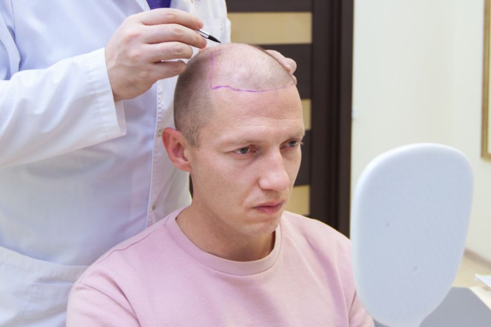 Where does hair transplant hair come from?