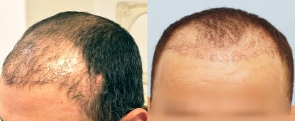 Example of a bad hair transplant