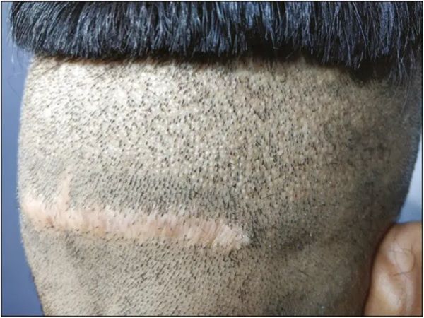 Example of an FUT hair transplant scar