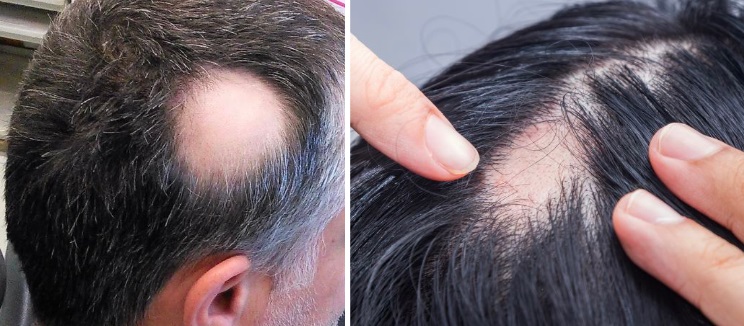 examples of alopecia areata