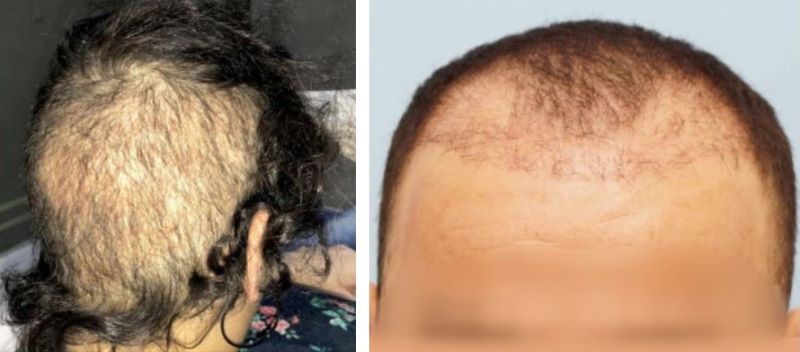 Examples of a failed hair transplant