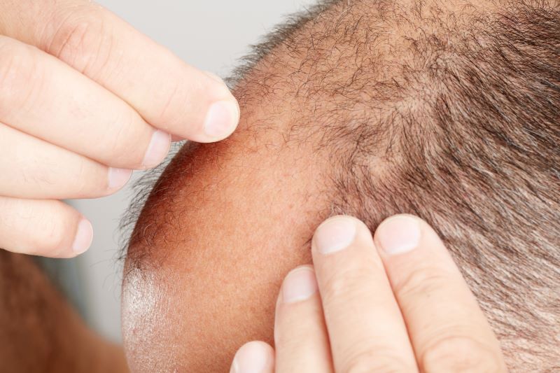 Healthy donor hair is important when assessing hair transplant candidates