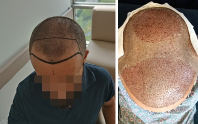 Patient before and after inflated graft hair transplant