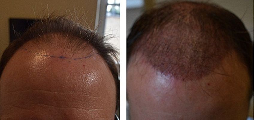 Patient before hair transplant and 1 month after surgery (FUE, 2500 grafts)