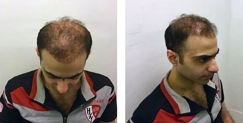 The poor results from a cheap hair transplant