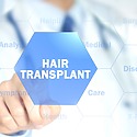 What Makes You A Good Hair Transplant Candidate?