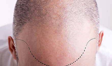 Hair Transplant Hairline