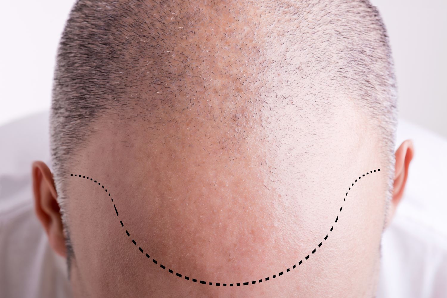 hair transplant hairline
