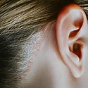 Scalp Psoriasis – Diagnosis And Treatments