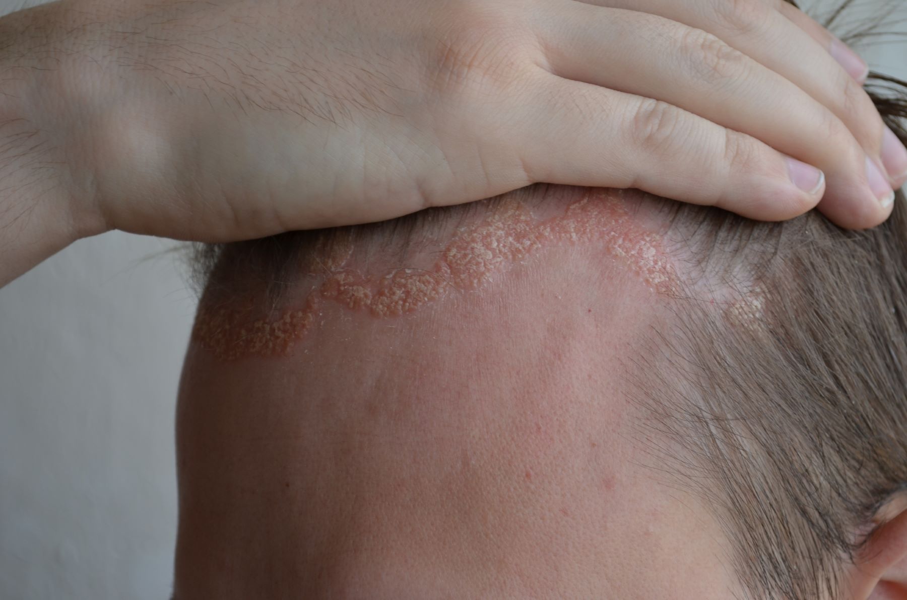 scalp psoriasis on the hairline