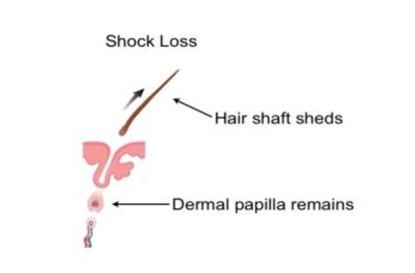 The mechanics of shock loss