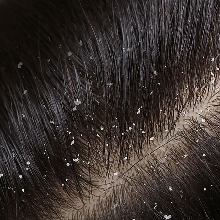 Dandruff on hair