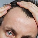 Can You Get A Hair Transplant Too Early?