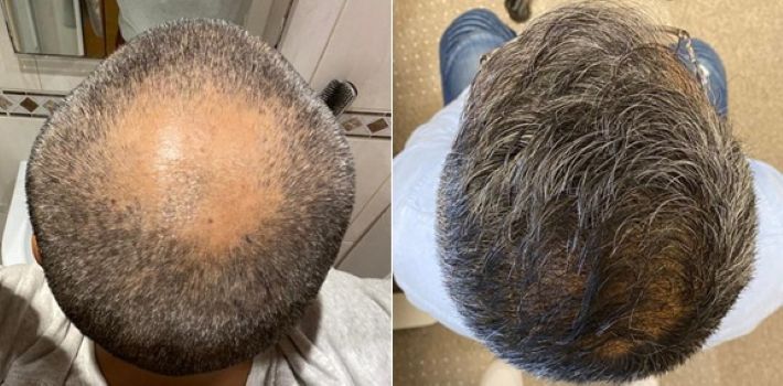Before and 12 months after a hair transplant