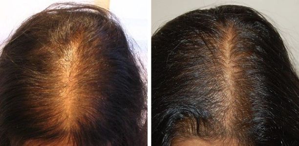 Female patient before and 12 months after 900 grafts FUT hair transplant