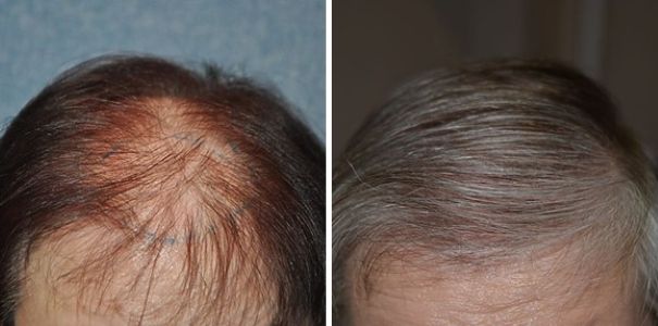 Female patient before and 9 months after 1600 grafts FUT hair transplant
