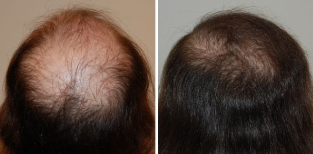 Female patient before and after 2800 grafts hair transplant