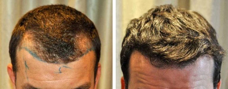 Patient's hairline before and after 1200 graft FUE hair transplant