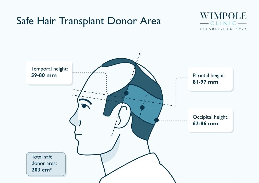 Safe Hair Transplant Donor Area