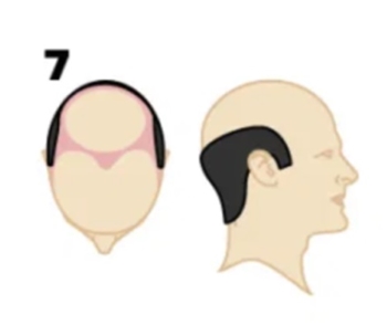 Hair loss at Norwood stage 7