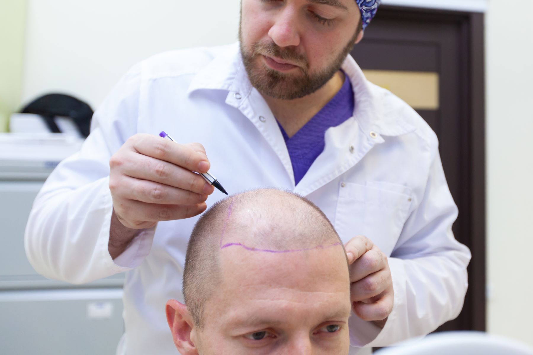 Hair loss patient having hair transplant consultation