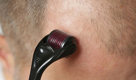 Derma Roller After Hair Transplant