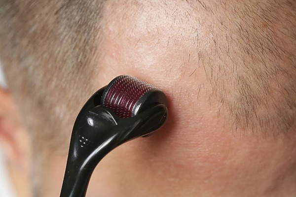 derma roller after hair transplant