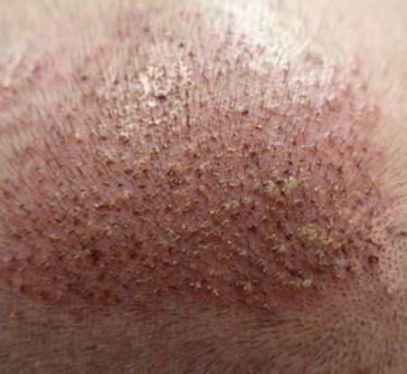 Crusting due to folliculitis
