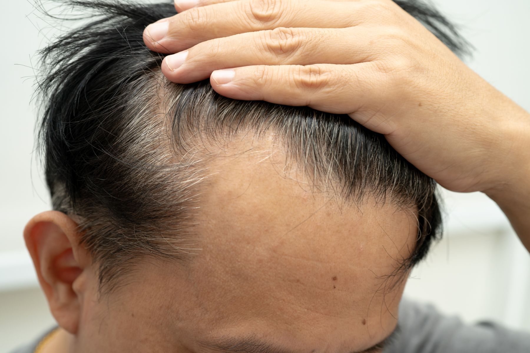 Hair transplant shedding side effect