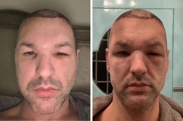 Swelling after a hair transplant