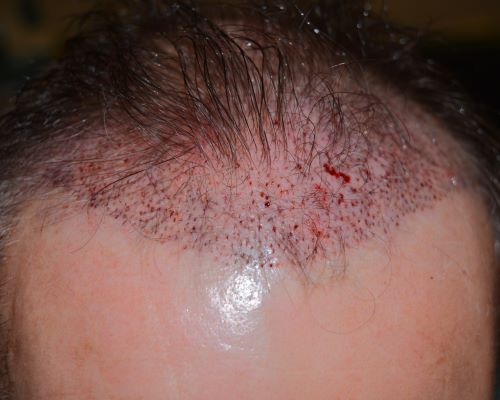 Patient's hairline immediately after FUE hair transplant surgery