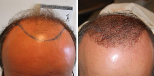 Wimpole patient before and 3 months after 2200 grafts FUE hair transplant