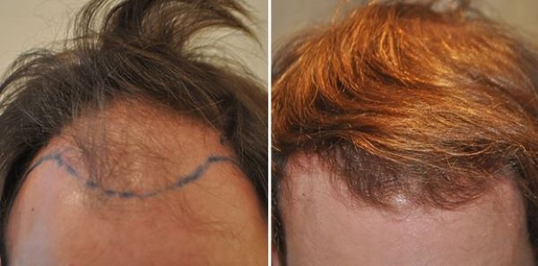 Wimpole patient before and 6 months after 2000 grafts FUT hair transplant