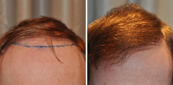 Wimpole patient before and 9 months after 2000 grafts FUT hair transplant