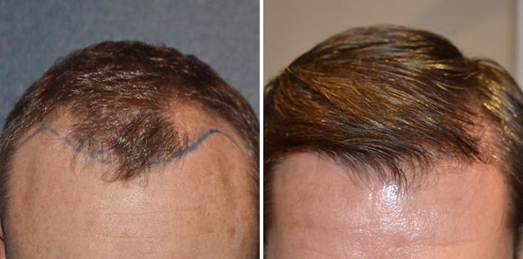 Wimpole patient's hairline before and 12 months after 2400 grafts FUT hair transplant