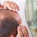 Why Do Hair Transplants Fail?