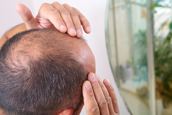 why do hair transplants fail