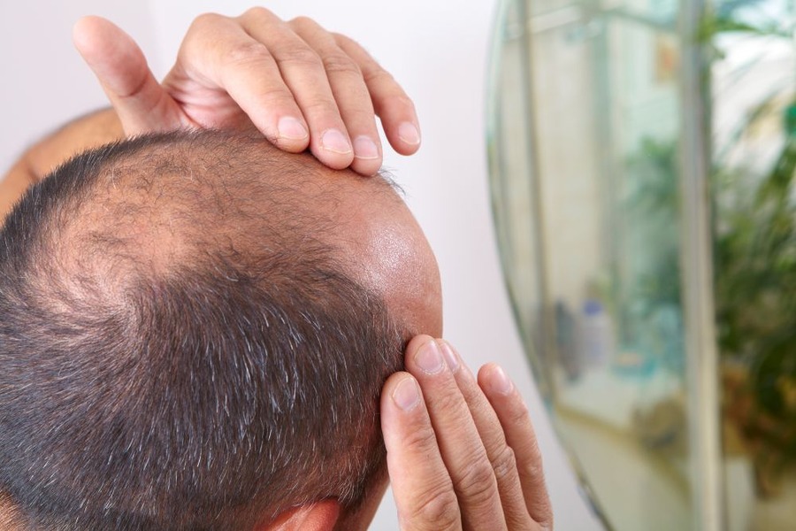 Why Do Hair Transplants Fail