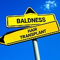 Why Are More People Getting Hair Transplants?