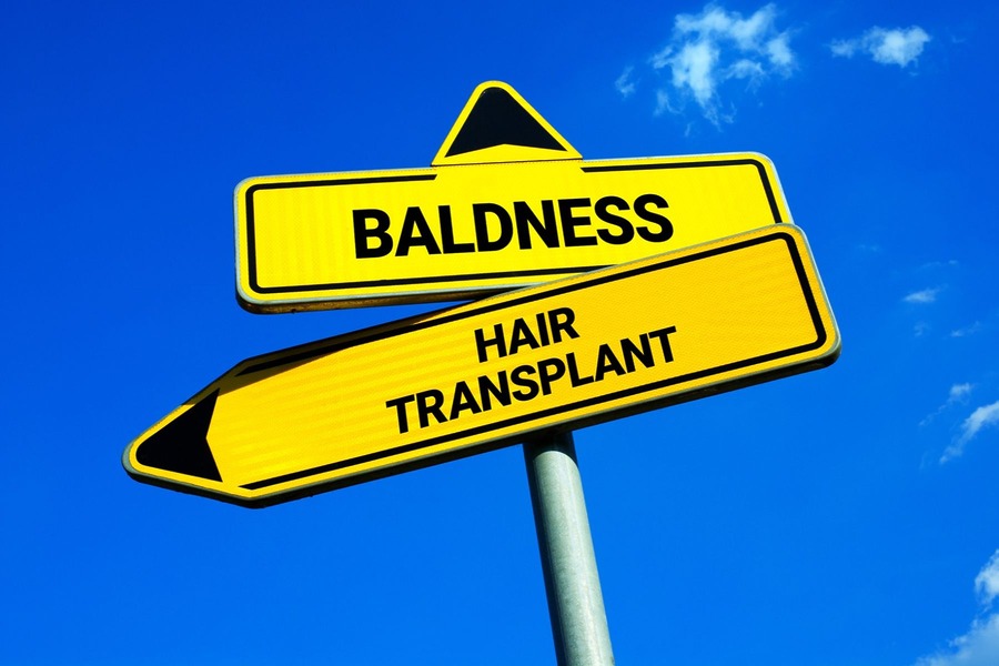 More People Getting Hair Transplants