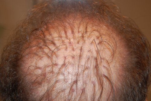 Patient with outdated hair plugs