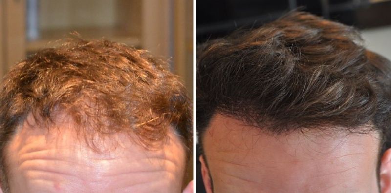 Patient’s hairline before and after FUE hair transplant